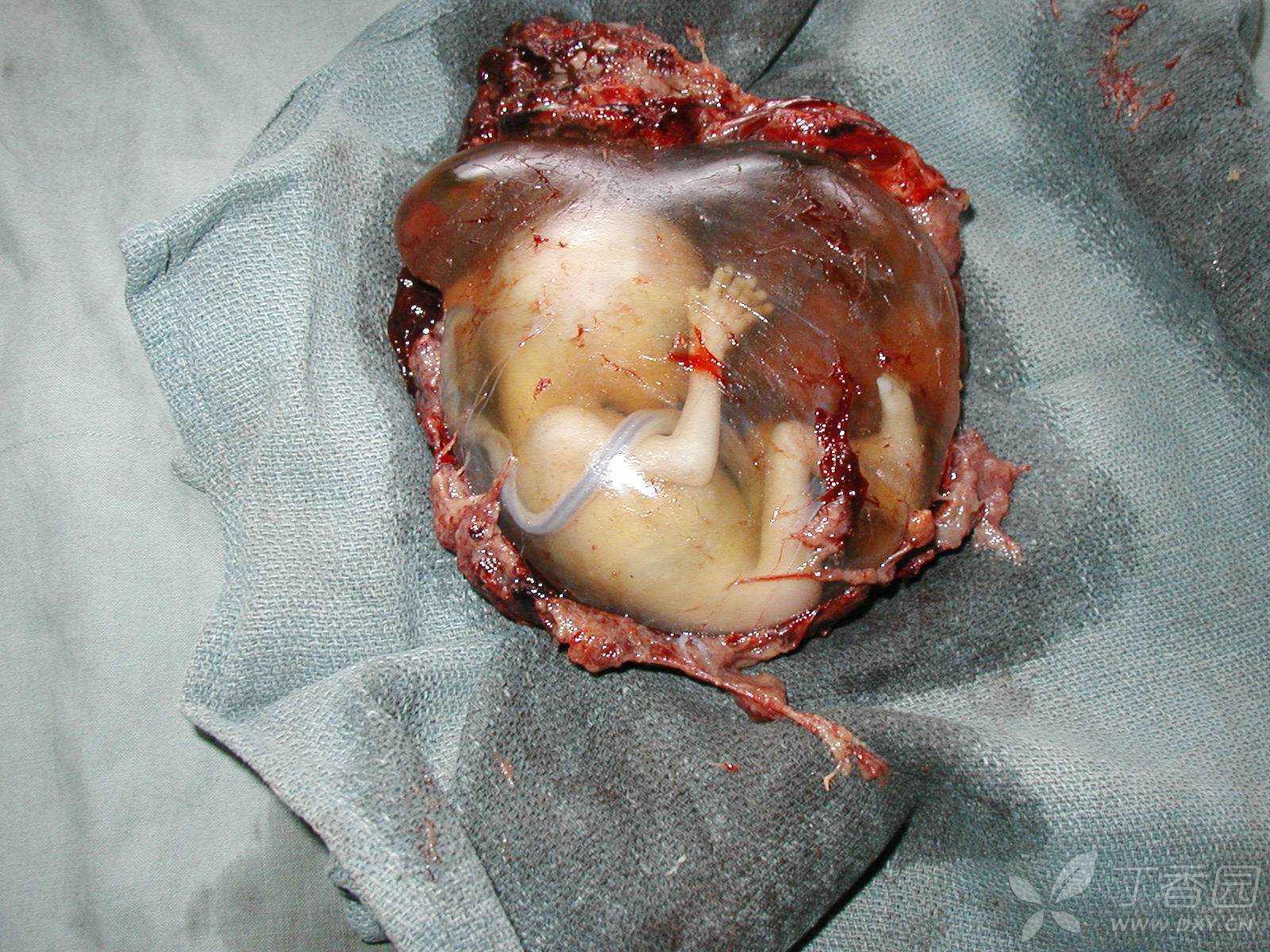 【罕见】剖腹探查发现的异位妊娠,你猜是哪个部位的?