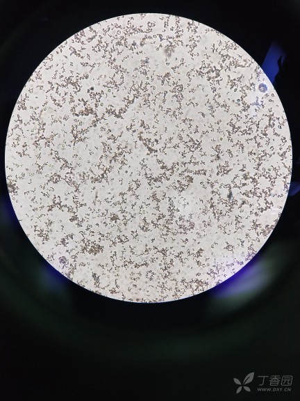 尿液磷酸钙结晶图片图片