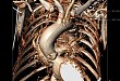 极低体重极度虚弱经颈动脉 TAVR 一例