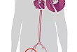 病例分享：西京医院心血管外科 ECMO 辅助下 TAVR 救治重度心衰患者一例