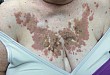 罕见病例：白血病患者的多发色素性皮疹
