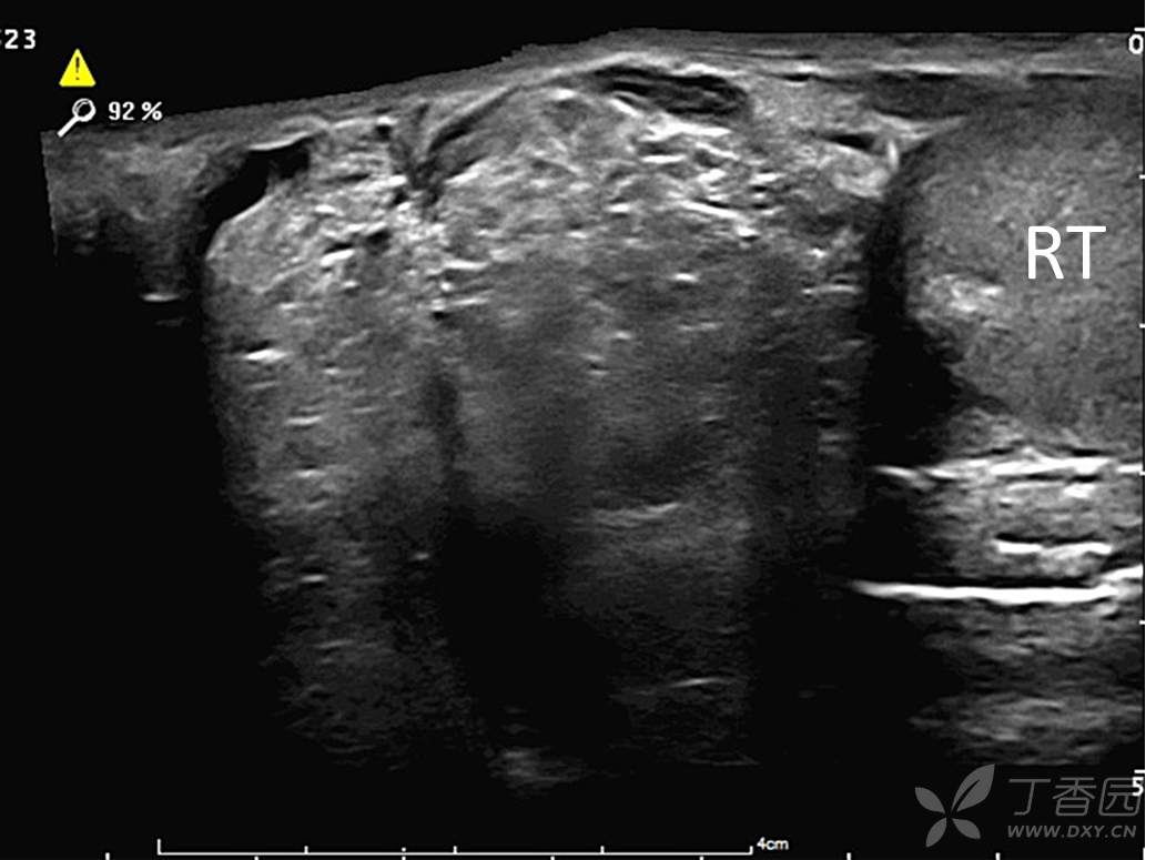 分享一例右侧腹股沟斜疝