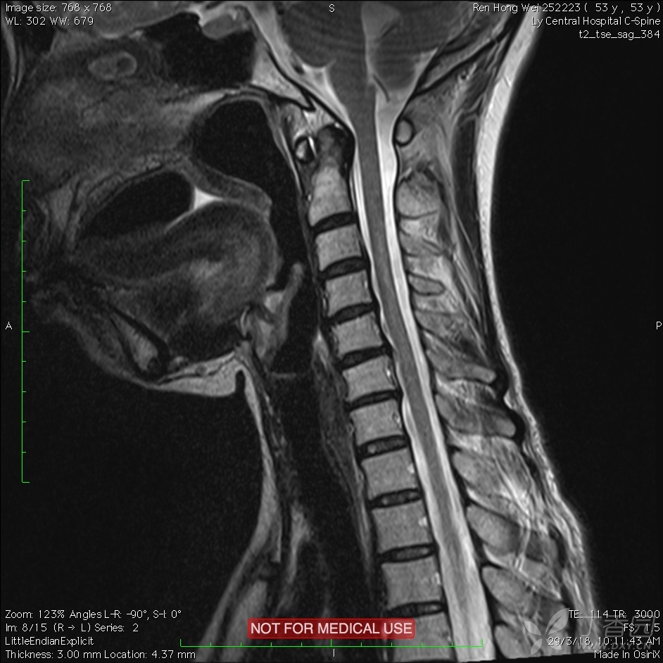 硬脊膜囊受压图片