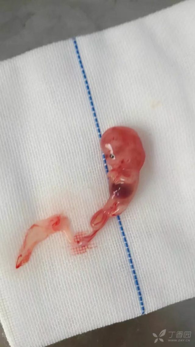 一个月流产的孕囊图片图片