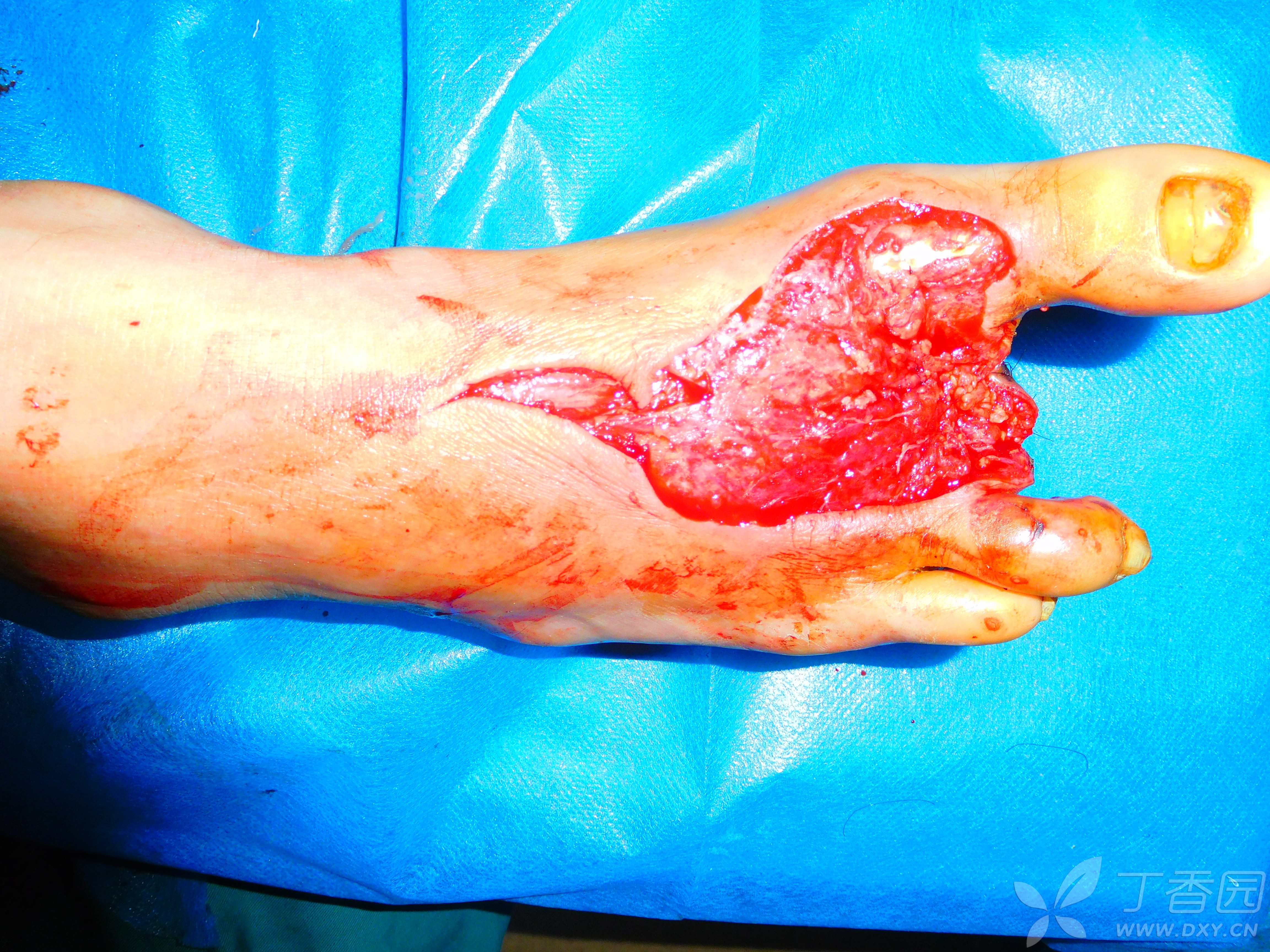 右足背局部皮肤软组织缺损行同侧股前外侧皮瓣修复