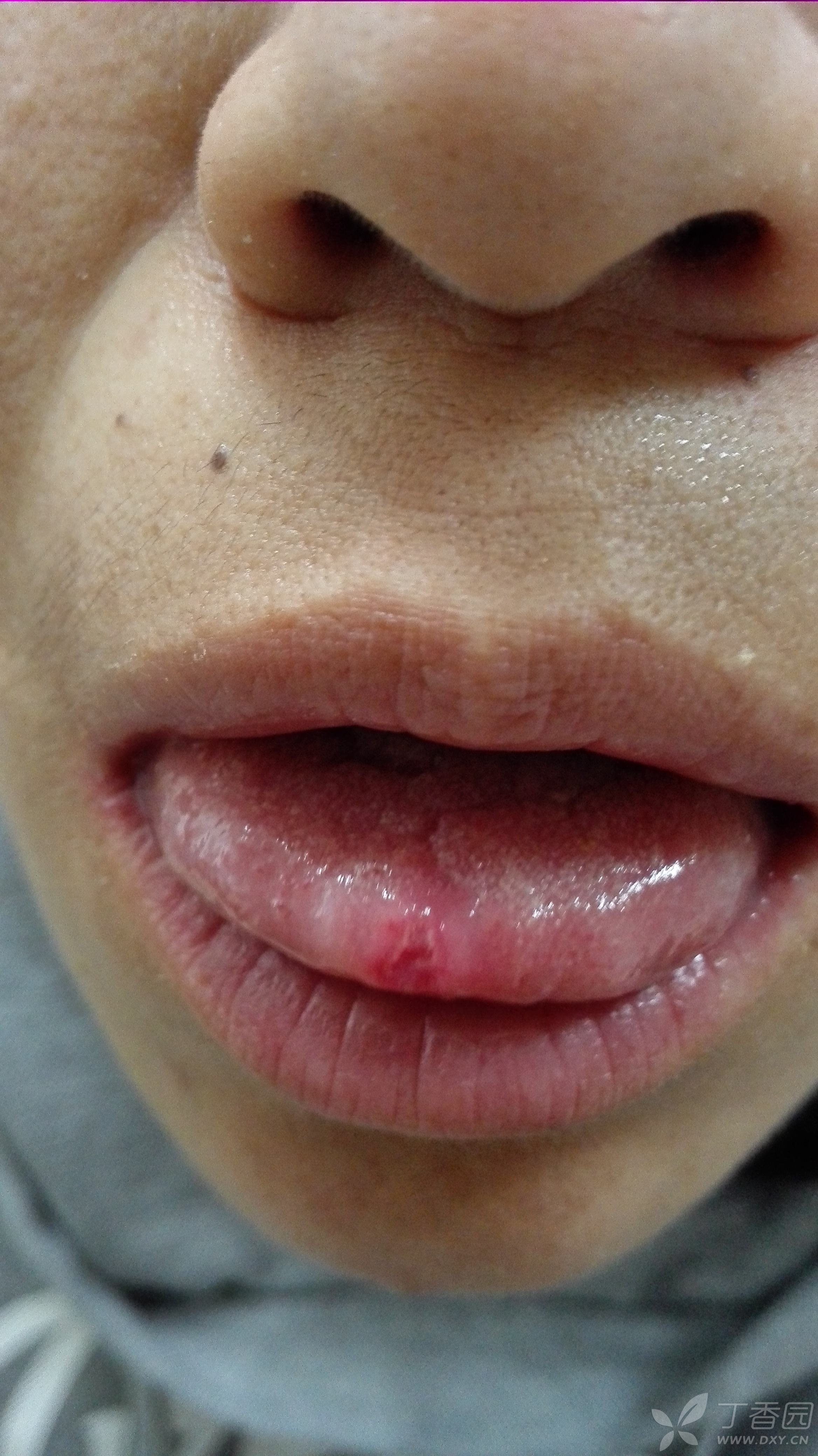 白塞病的口腔溃疡图片图片