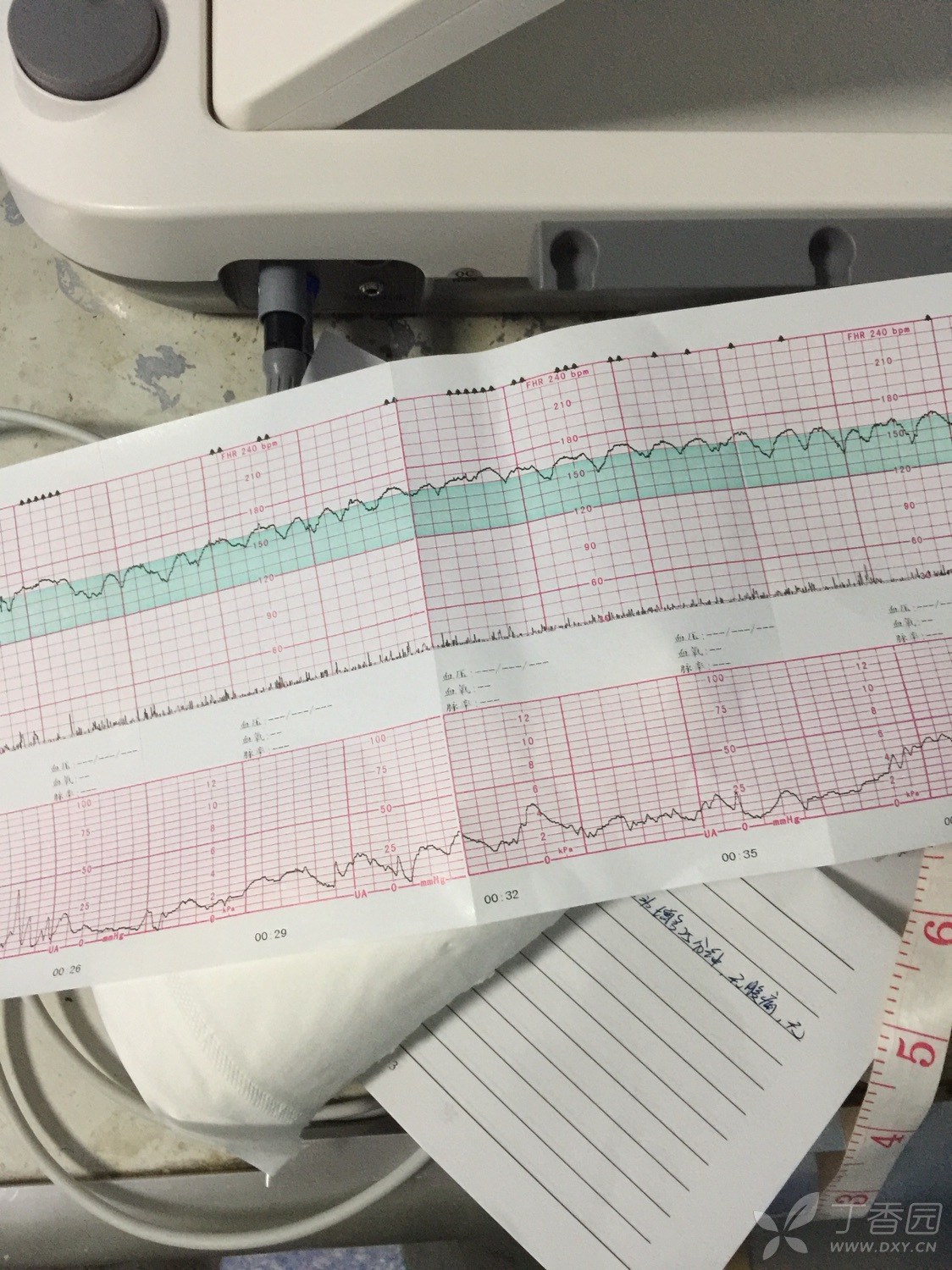 请大家看一下这个胎心监护