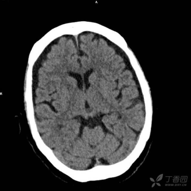 典型松果体囊肿?