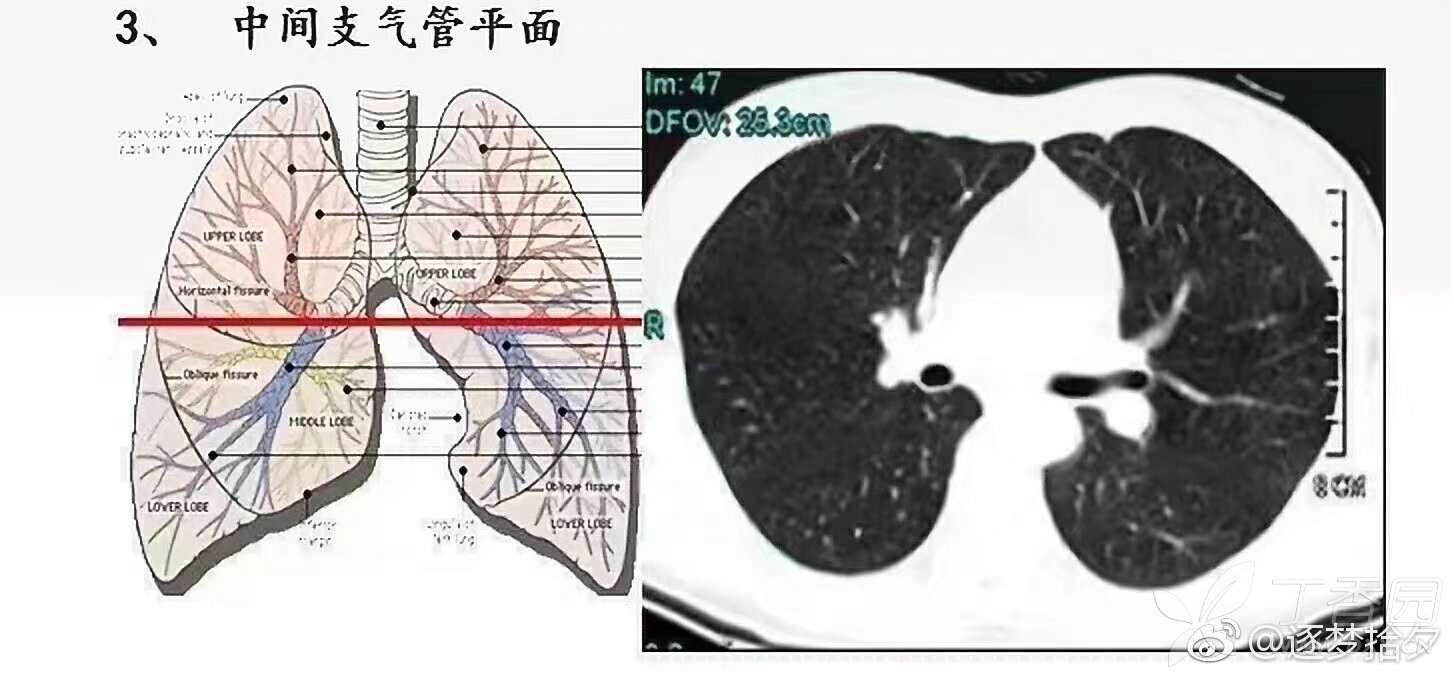 肺不张ct图片图解图片
