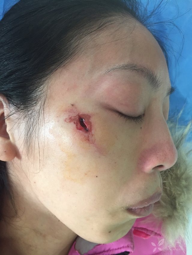 面部缝合,缝的怎么样?请拍砖!