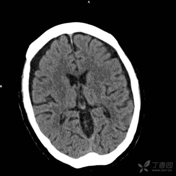 典型松果体囊肿？