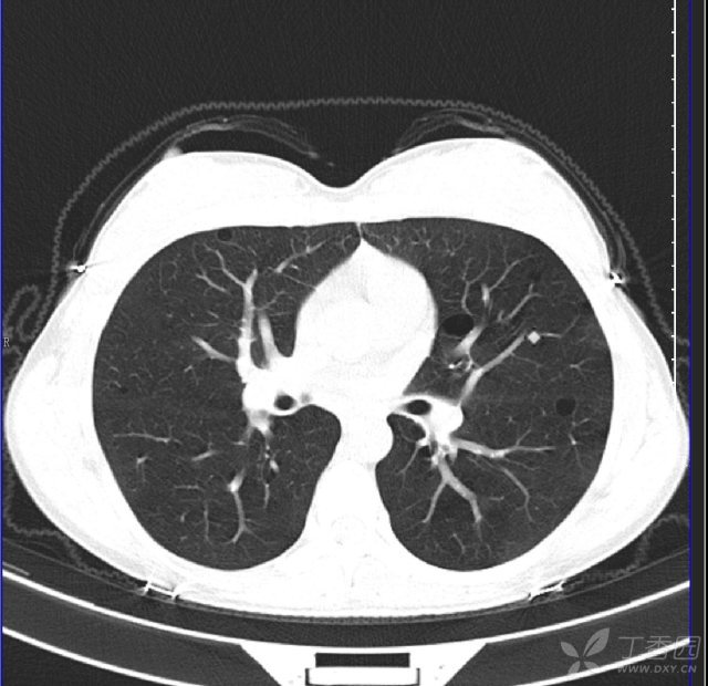 31岁女性,因咳嗽咳痰7天,发热3天急诊就诊,胸部ct提示两肺多发囊气肿