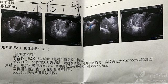 子宫肌瘤是什么情况下会有的 3274504053874628067-16w.jpg!w640