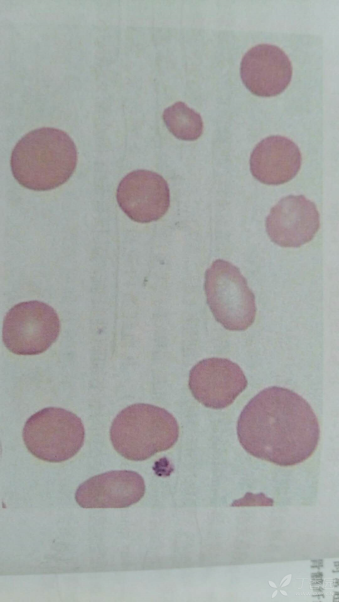 遗传性中,红细胞膜缺陷的有: 遗传性球形红细胞增多症