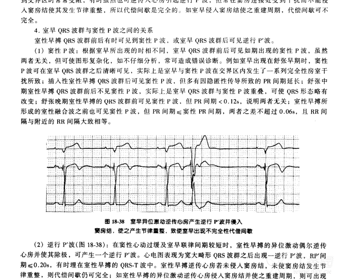 心电图简谱_正常心电图图片(3)