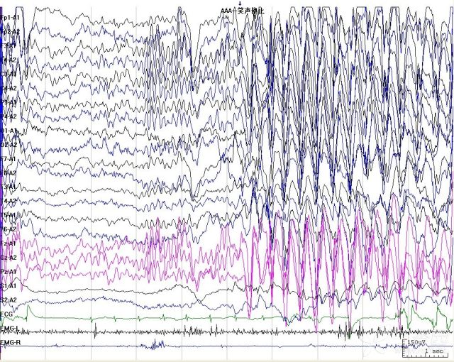 失神发作脑电图特点图片