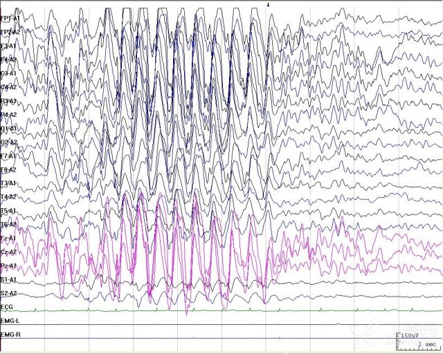 热性惊厥脑电图图片