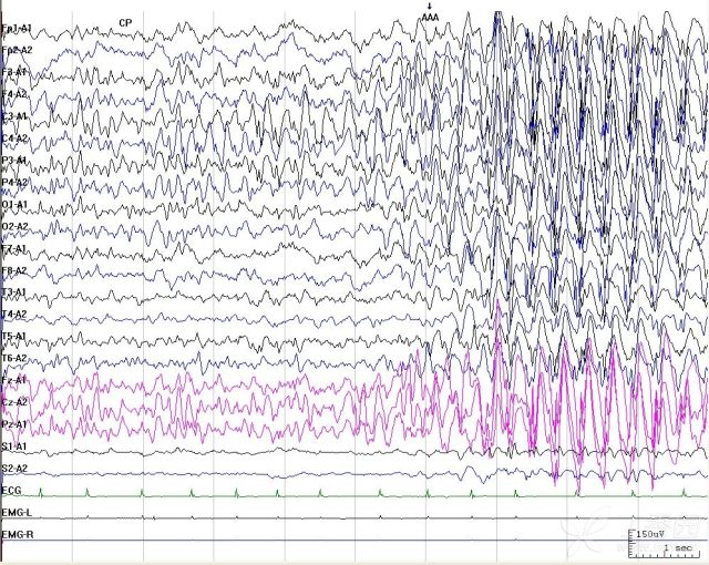 失神发作脑电图特点图片