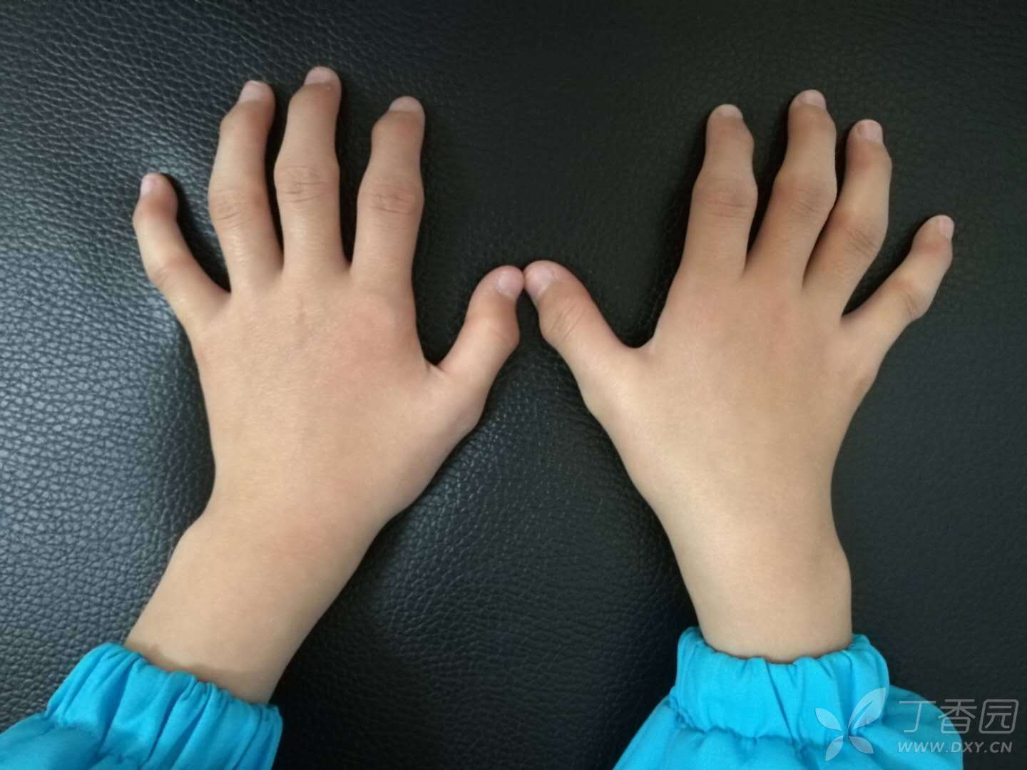 儿童手指关节肿大图片图片