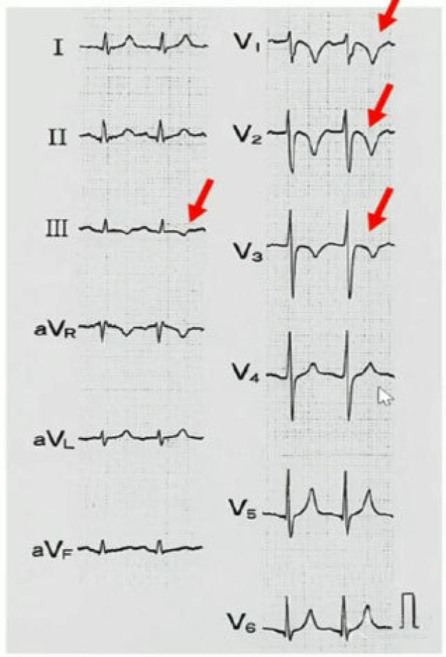 额面电轴:右偏是"典型"表现,左偏也不少见 横面电轴:顺钟向转位,胸