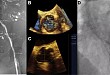 零造影剂 TAVR 为重度肾衰患者带来一线生机