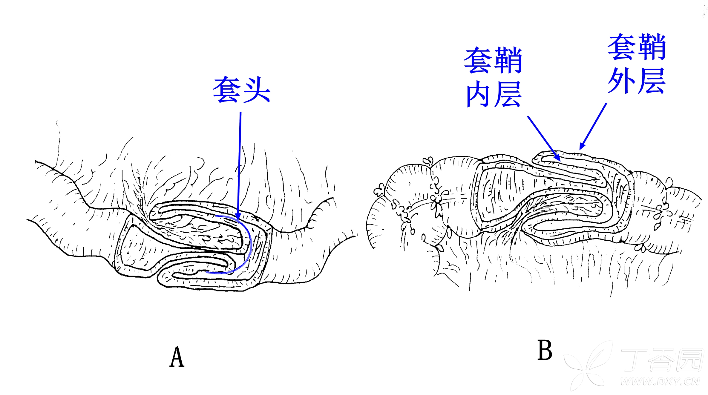 肠套叠杯口状图片