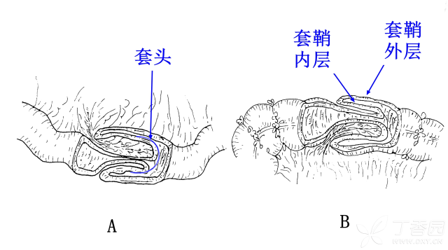 宝宝灌肠的原理是什么_上环是什么原理图片