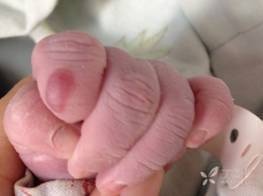 吸吮水泡 典型图片：新生儿吸吮水疱，你见过吗？