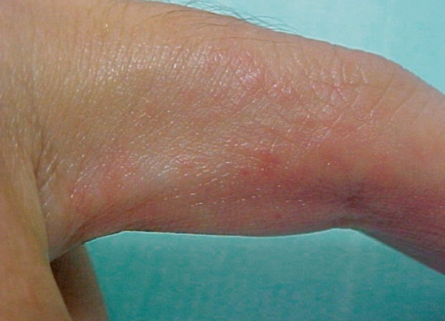 一位青年男性表现为手指瘙痒性红色丘疹(图 4,按疥疮外用扑灭司林