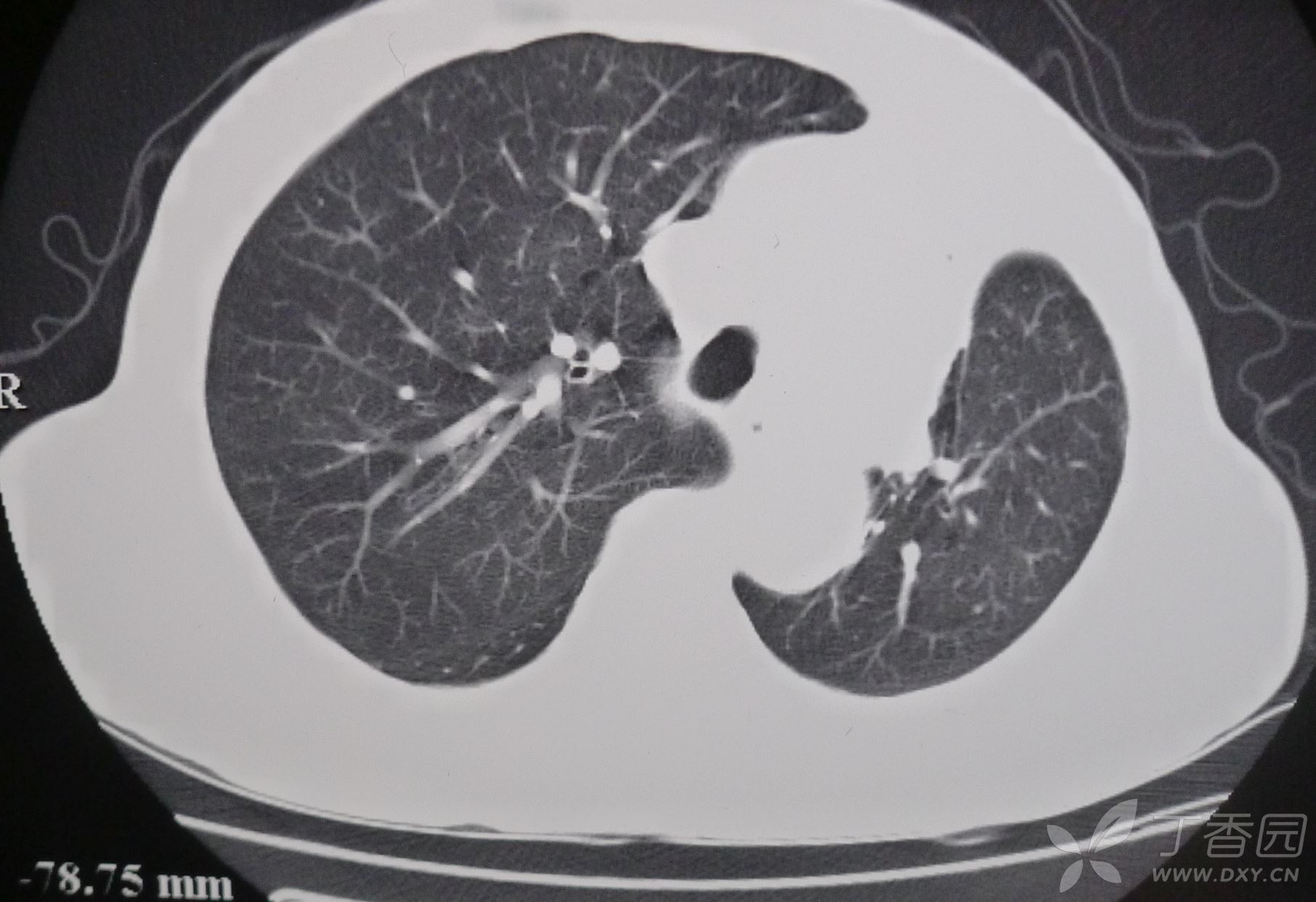 中央型肺癌图片