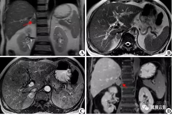 在血行性转移的好发部位中占第四位,肾上腺转移瘤常见的原发性肿瘤是