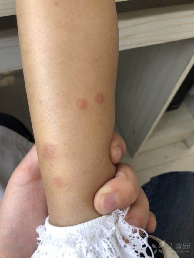 四肢皮疹反复发作一周,不痛不痒,伴有关节水肿