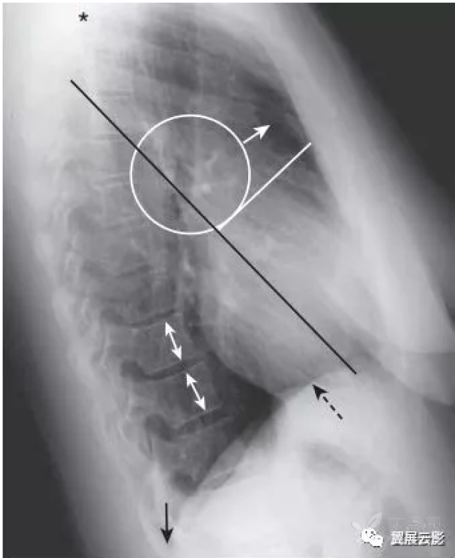 图2-2:正常左侧位x线胸片