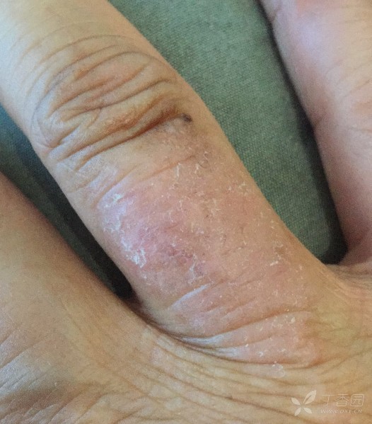 显微镜下直接看到的是菌丝吗? - 皮肤与性传播疾病讨论版 -丁香园论坛