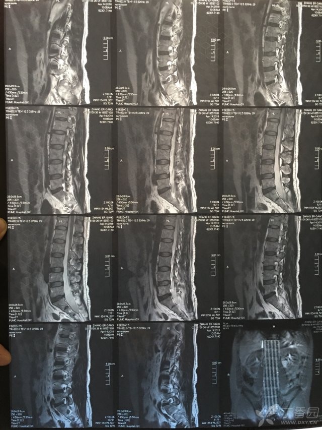 各位老师,帮忙看看此病例符合腰肌劳损诊断吗?