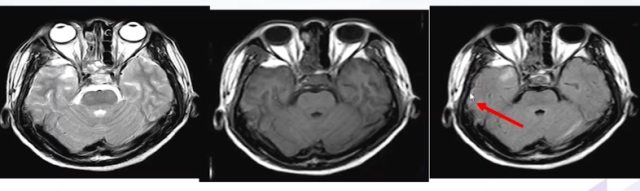 颅脑mri11.jpeg