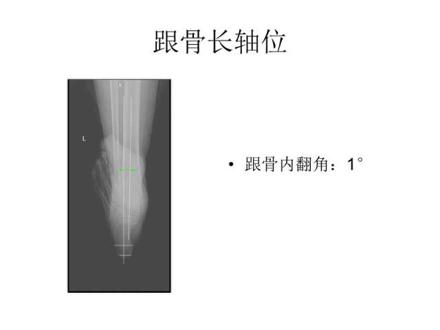 跟骨轴位图片x线图片图片