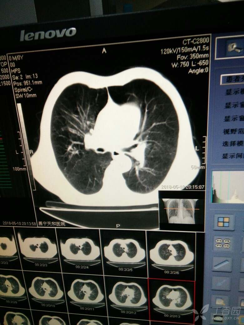 各位老师请你们帮忙看看,这个肺部阴影考虑是什么?