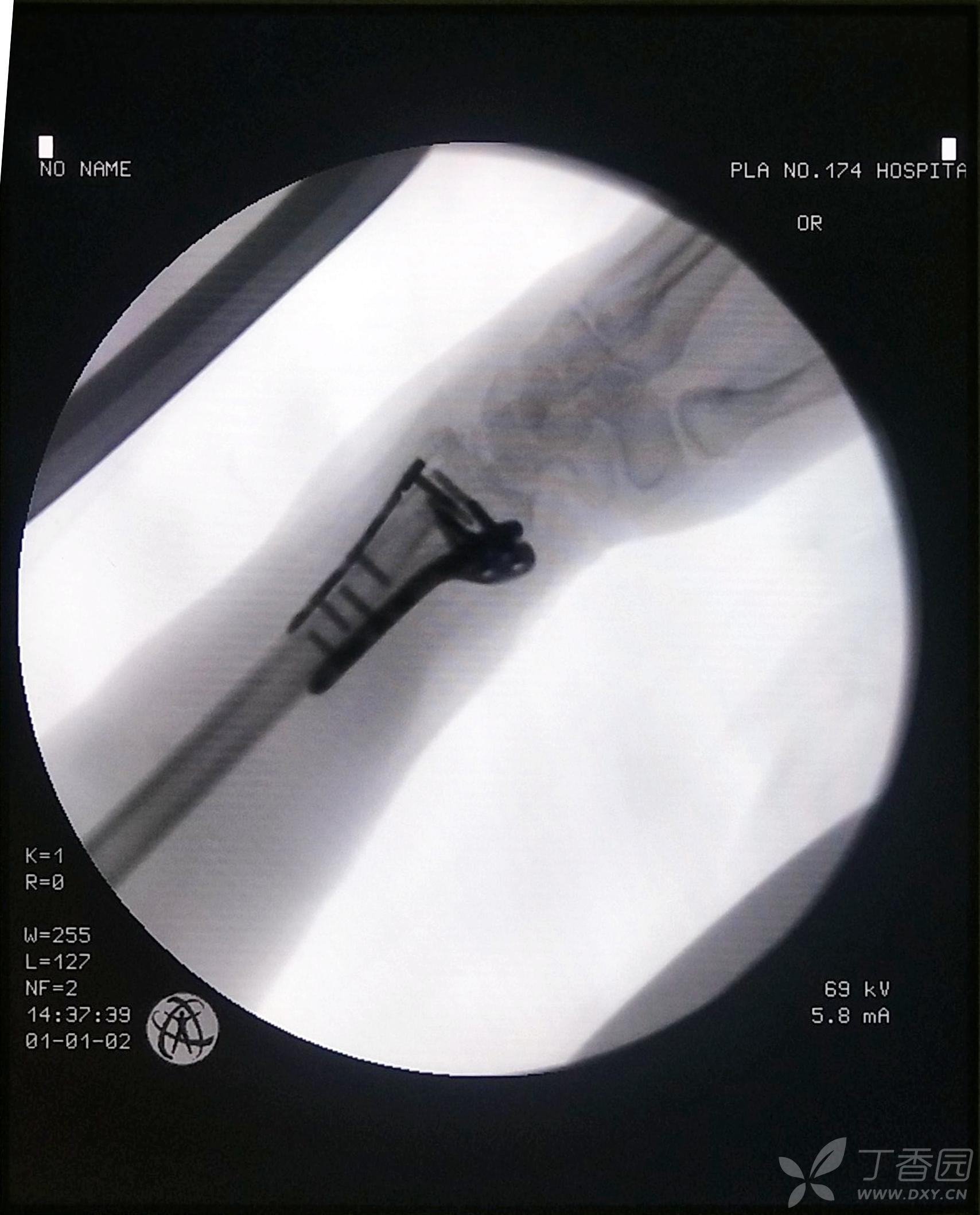 黄骨头桡骨远端骨折手术日记1——桡骨远端粉碎性骨折掌背侧联合入路
