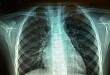 NEJM 丨慢阻肺三联吸入治疗是否优于二联吸入治疗？