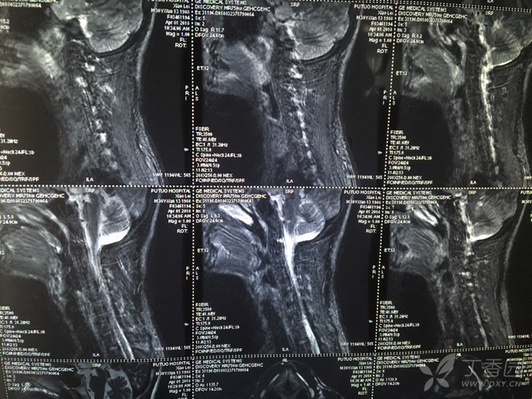 颈椎开刀 搜狗图片搜索