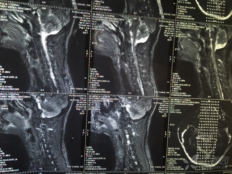 颈椎开刀 搜狗图片搜索
