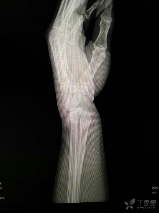 左腕关节活动障碍,左手诸指活动受限,感觉及末梢血运 辅助检查:腕关节