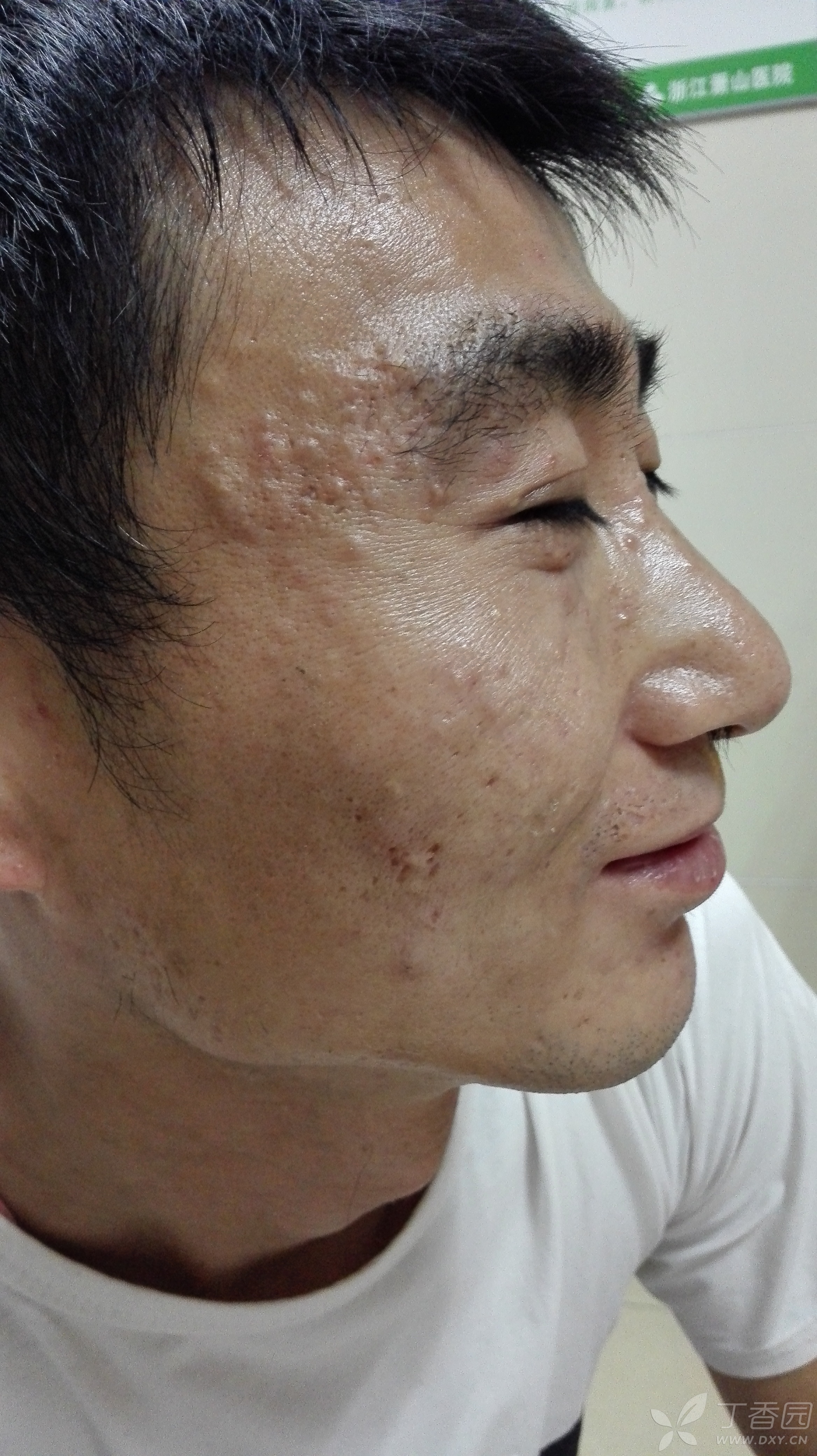 患者男45岁,颜面部粟粒性狼疮.按痤疮治疗,服用泰尔斯半年无效