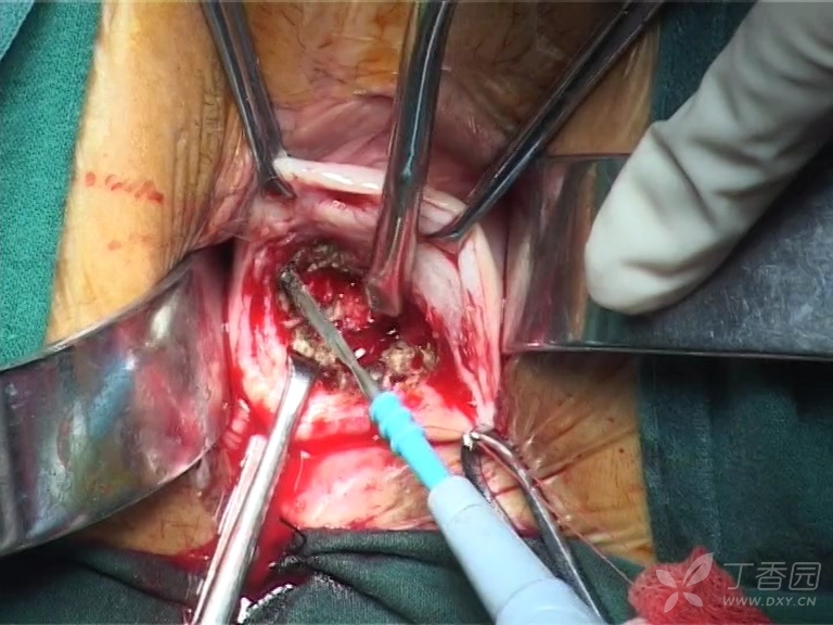 宫颈锥切手术过程图图片
