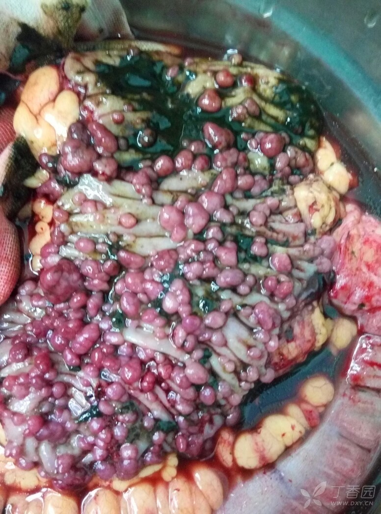 家族性腺瘤性息肉病,切除后标本,太恶心了不能再放在手机里了.