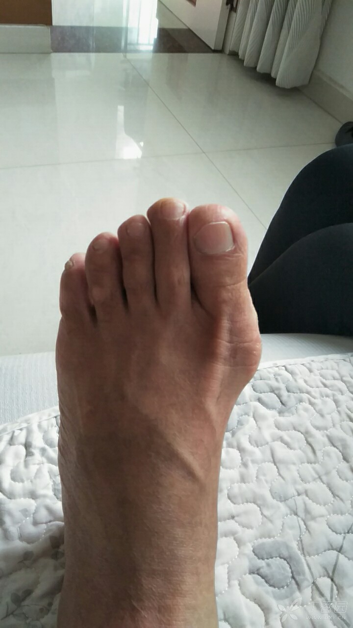 拇外翻是否需要手术治疗?