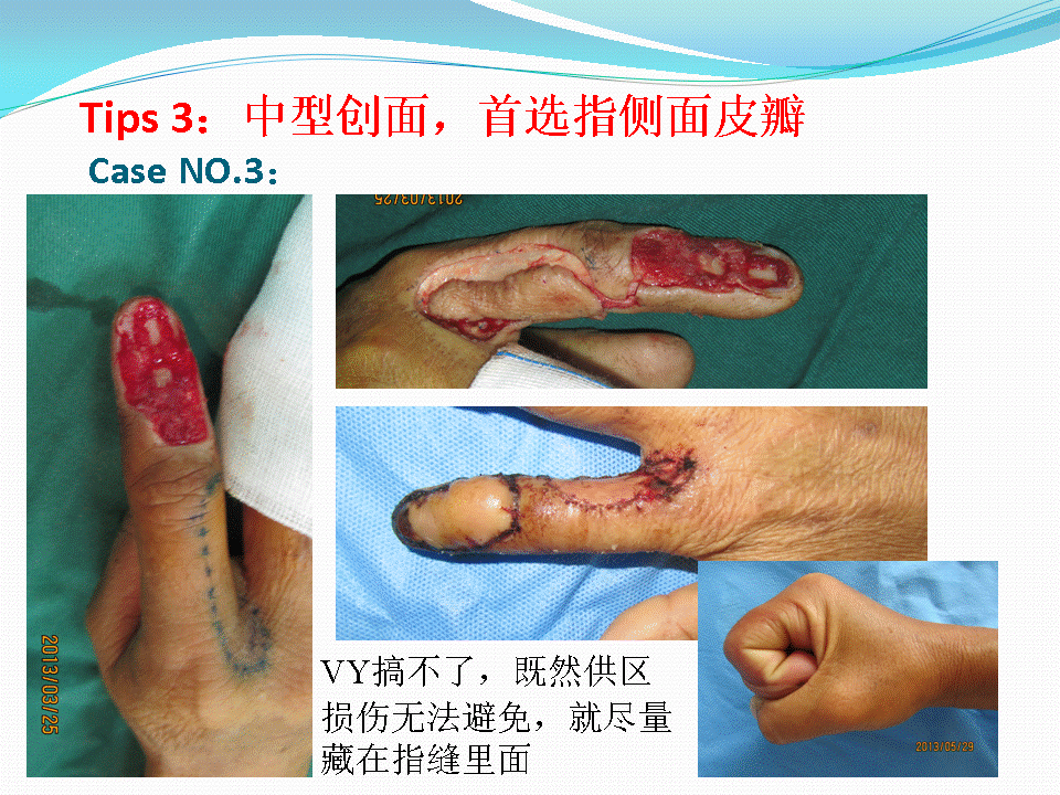 刘应良:手指创面皮瓣修复的六项原则&推荐建议