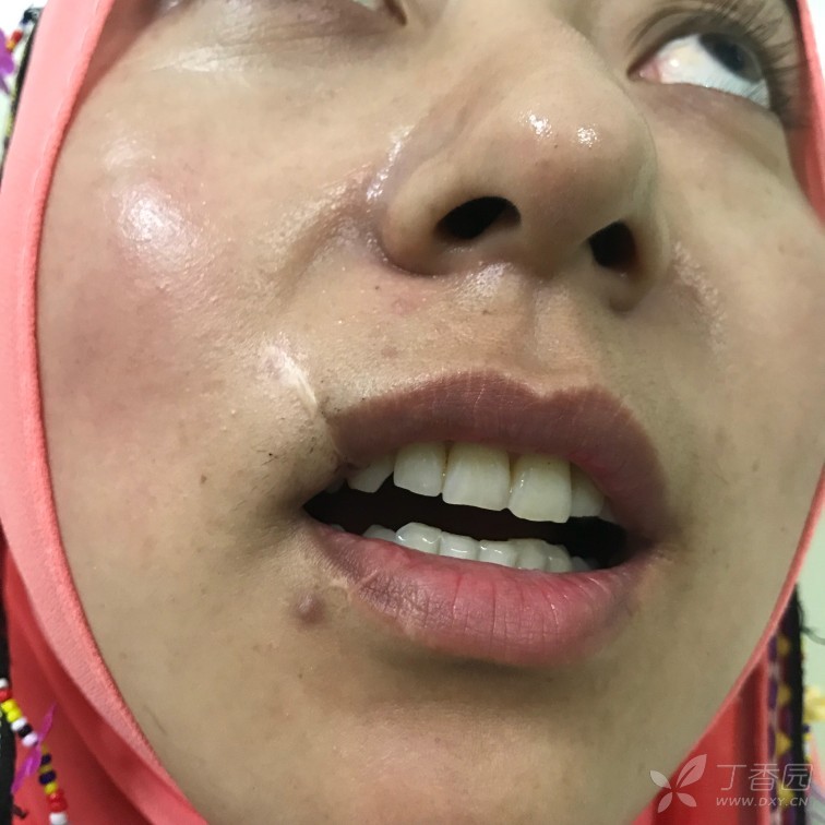 一例上唇瘢痕,皮瓣怎么设计才能使唇红缘对齐 [病例帖]