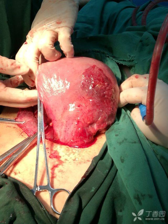 胎膜早破剖宫产,子宫上的这个东西没见过,有人知道是什么吗?